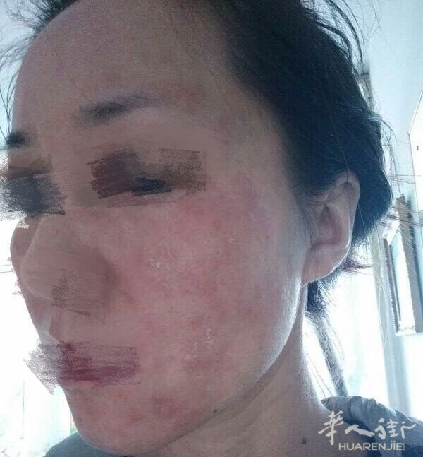 面部过敏性皮炎和激素依赖性皮炎的症状是