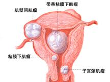 有人治过子宫肌瘤吗   2.jpg