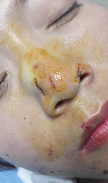 中国女游客泰国吻蛇被咬鼻子 血流满面