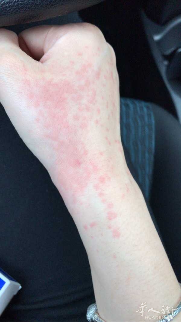 谁知道身上起红疹用什么药。昨天晚上忽然发起