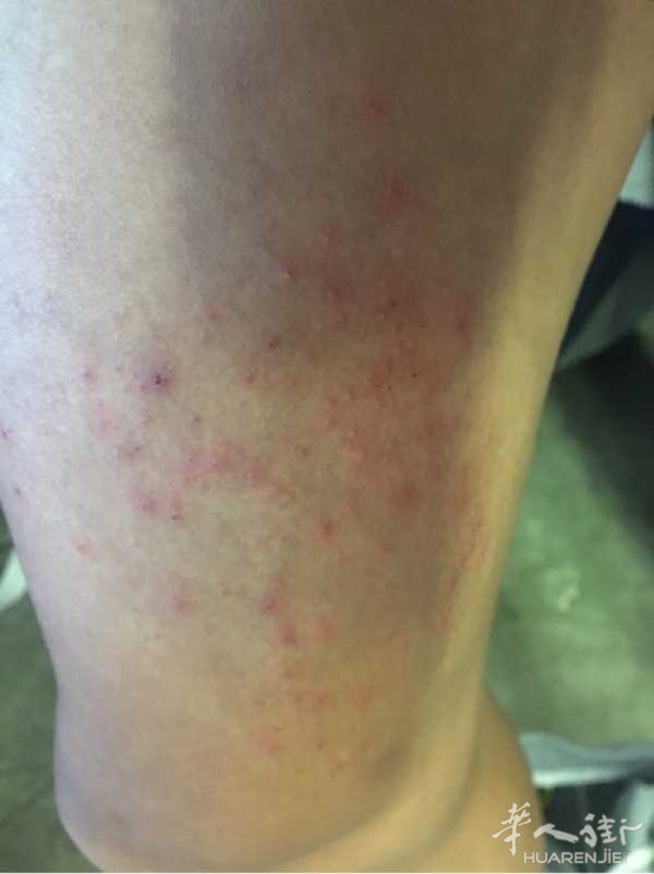 每年这个季节的时候皮肤就会痒.请问一下街友