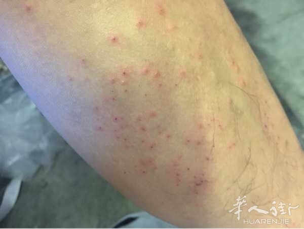 每年这个季节的时候皮肤就会痒.请问一下街友