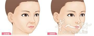 有效去除法令纹
