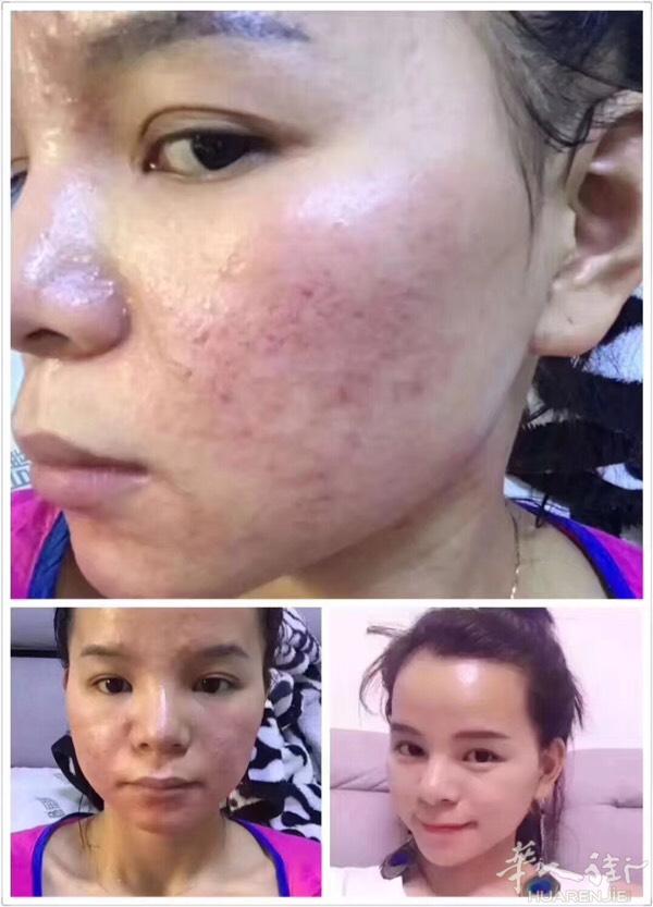 如果你坚持了9个月以上现在使用的护肤品解决不了皮肤