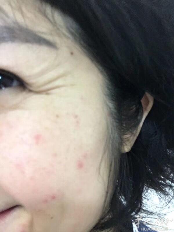 皙之密真实反馈：看看我的顾客美女，用了皙之密痘痘