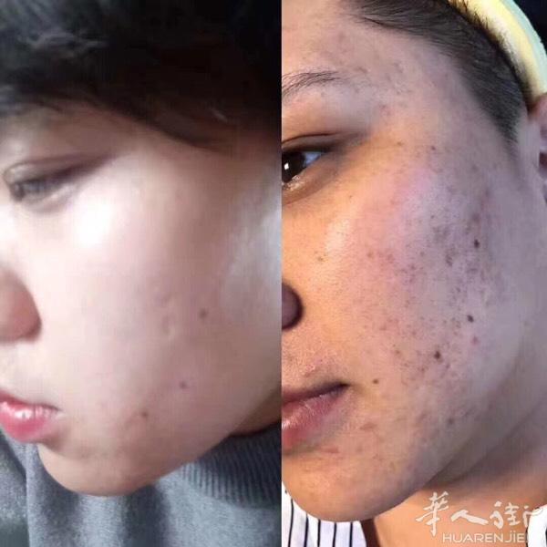 经常皮肤反复过敏和痘痘肌肤，皙之密百分之一百能修复