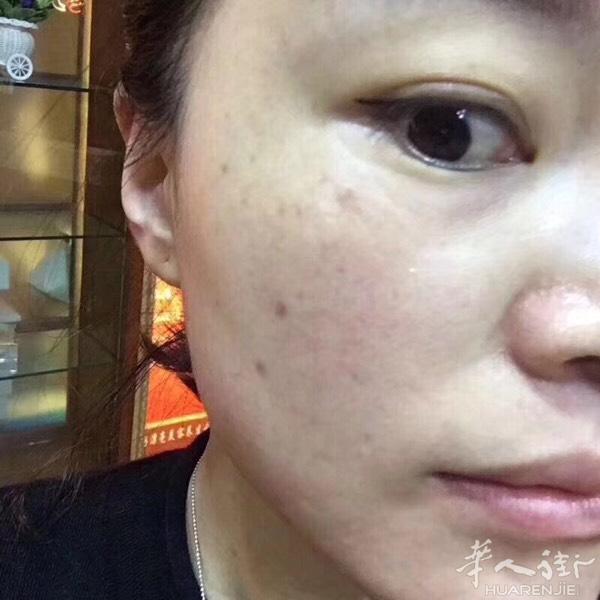 用上神奇的皙之密脸上的痣都淡化没有了，[色]这可是