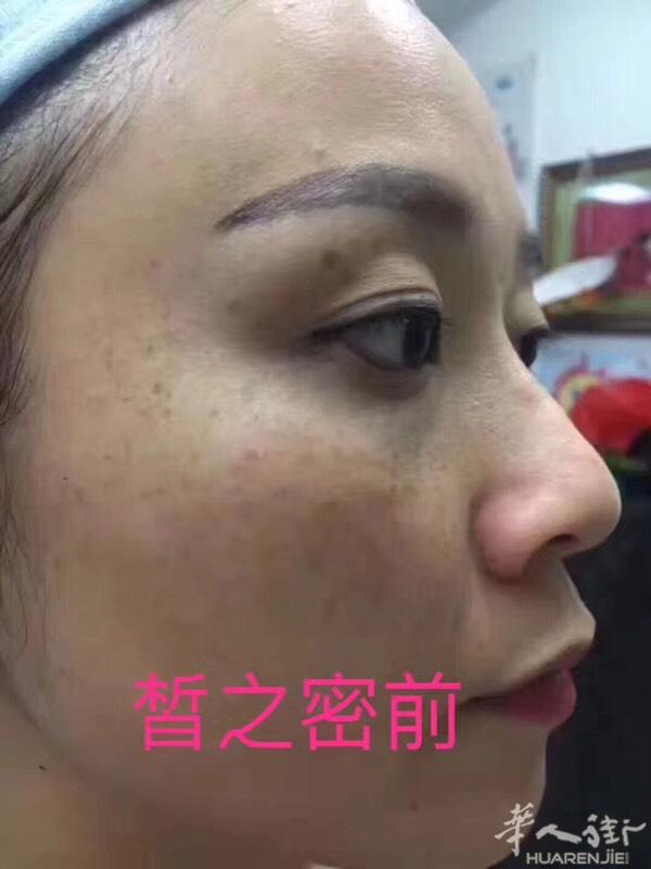 皙之密反馈1️⃣
用皙之密之前脸上最大的问题是斑！