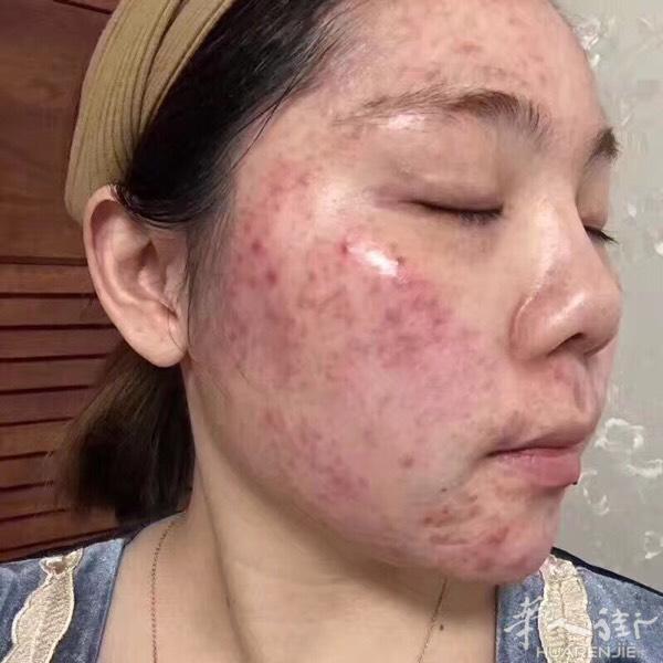 福鼎的珊珊又是激素脸😱又是痘痘肌😱尝试了很好方