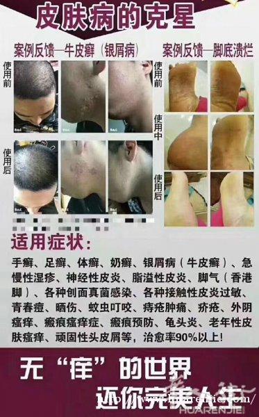皮肤病特效药