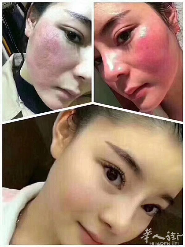 目前中国女人80%都是激素脸，而且自体代谢不掉激素