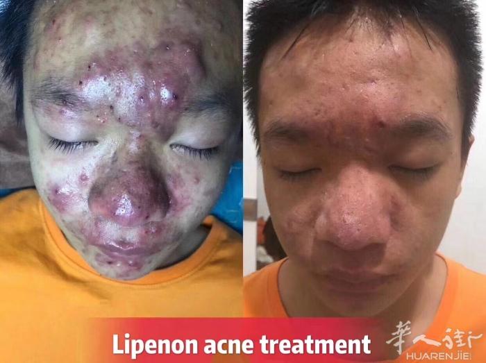 长有被痘痘困扰的朋友吗？
我在国内是做专业祛痘治疗的，经常来巴黎，有需要治疗痘痘
