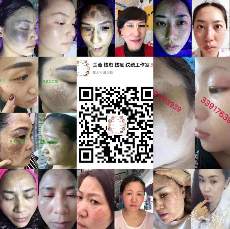 专业祛斑 祛痘 纹绣 扁平疣 3391763939