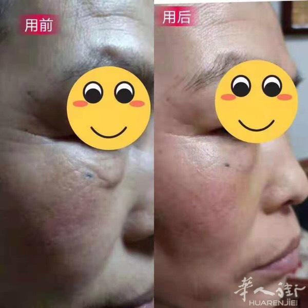 不打针，不埋线，只是轻轻涂抹五分钟立刻见效，无需恢