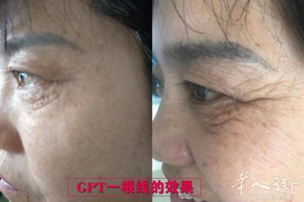 GPT黄金线雕5分钟，不开刀不破口不打针！在家自己
