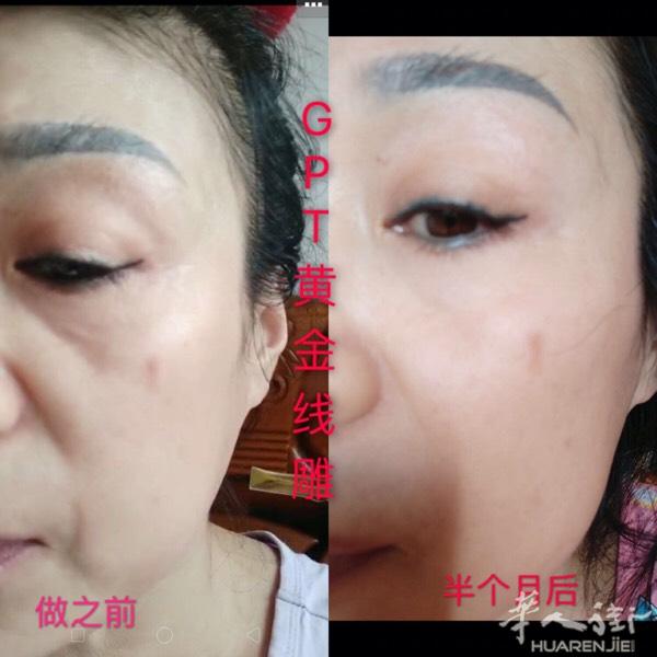 五分钟一次见效，不用打针，不用破皮，不用动手术一次