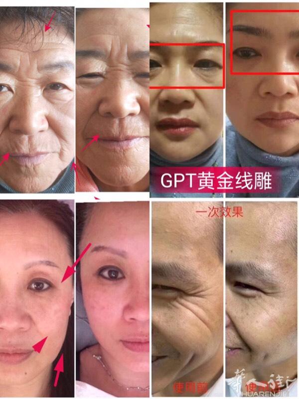 五分钟去皱一次见效！GPT黄金线雕🔥100%无副