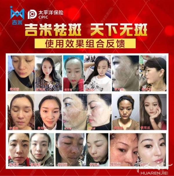 想祛斑的美女赶紧预约吧3335808599效果非常