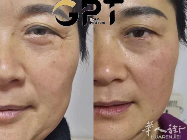 五分钟去皱一次就有效果，不开刀不、不破皮，不手术，