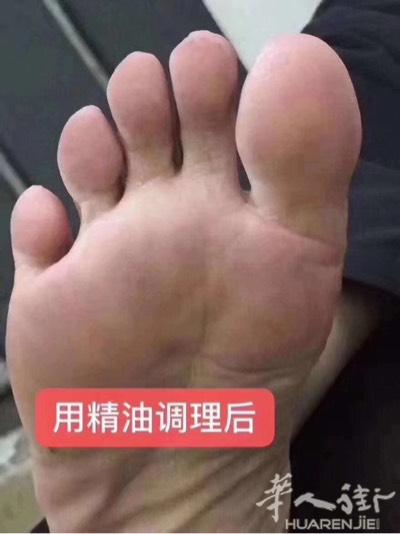 [捂脸][捂脸]一开始我都不知道精油可以缓解脚气[