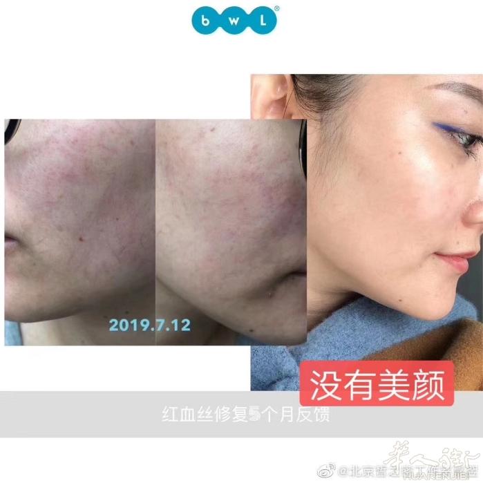 红血丝使用皙之密5个月反馈（微信：ITL88588）
换一套护肤品给皮肤机会
皙