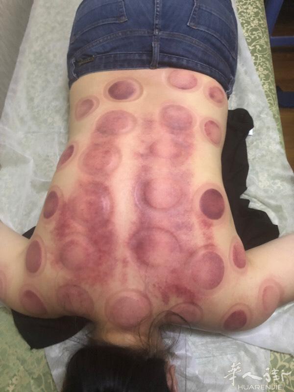 有需要专业推拿刮痧拔罐针灸艾灸推油按摩脚等可以联系