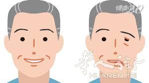 专治  中风 嘴歪