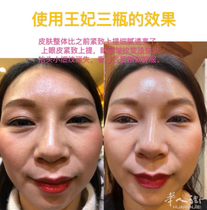 来，点开看看‼️‼️‼️ 使用王妃3瓶的效果对比🆚 皮肤紧致上提，眼部皱纹变浅