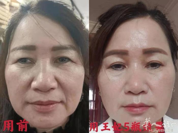 完全被这个效果震惊了‼️‼️ 我们家客户使用王妃5瓶的效果对比，眼袋眼部皱纹淡化