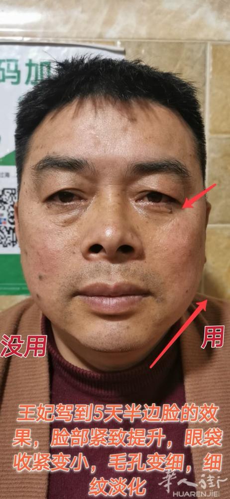 [爱心]王妃驾到新案例出炉 我们衢州又一位徐总，亲身体验半边脸5天的真实效果，他