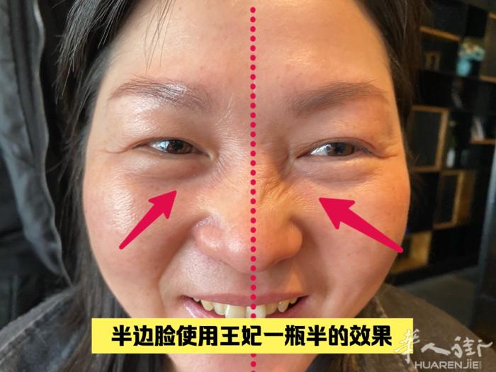 『瓶子里的超声刀』 每天喷一喷轻松实现逆龄蜕变 看看我们客户半边脸使用王妃的对比