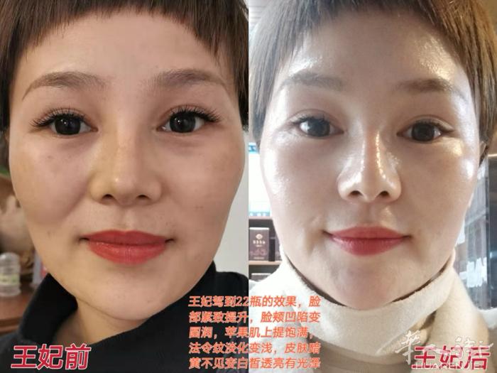 [爱心]王妃驾到22瓶的效果  安徽黄山吴宏芳吴总在没有遇上王妃前，皮肤暗黄、松