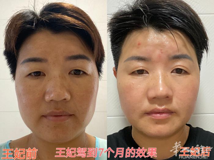 运营合伙人姜爱华用了 王妃驾到7个月的真实效果，脸部紧致提升，法令纹，脸上黑斑淡