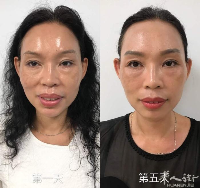 徒手微雕，五次，这样的改变是不是你想要的，十次？二十次呢？不可想象。爱美的姐妹可