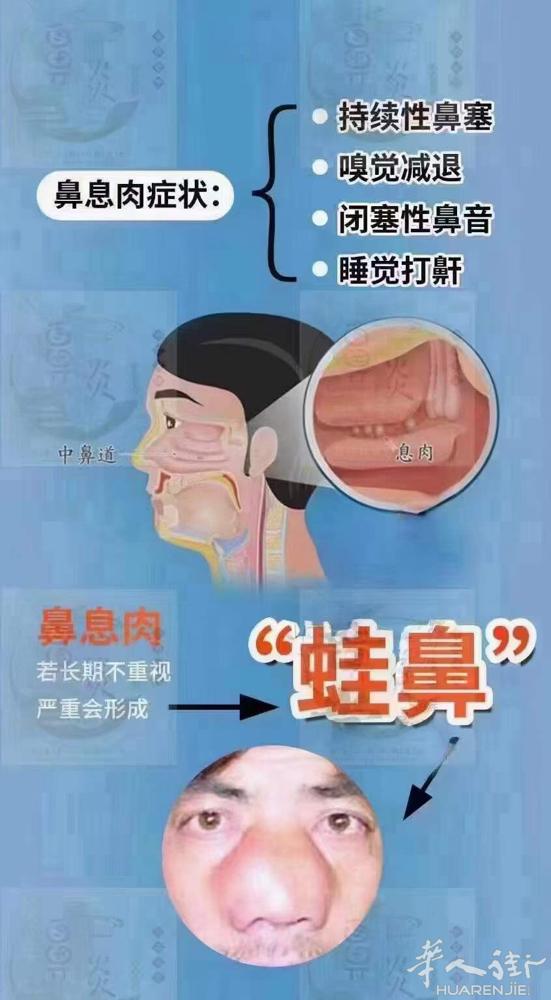 祖传秘方专治顽固鼻炎 中药配制 无副作用 不打针 不手术 不吃药 主治疗： 急慢