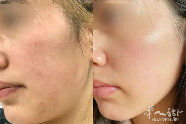 带你了解水光针的真实效果！  #Padova中意美莱医美微整中心#