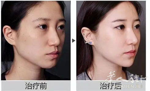 解答你对激光嫩肤的疑问! #Padova中意美莱医美微整中心#