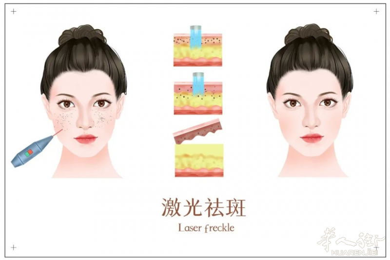 重拾纯净肌肤，激光祛斑美丽启程！  #Padova中意美莱医美微整中心#