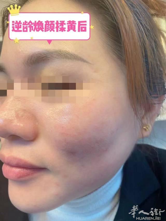 parto中国街纤瘦美容美体专业减肥去斑，不打针，