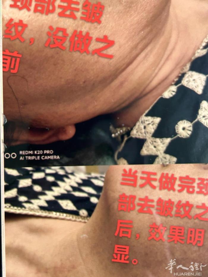 🔥《专业去颈纹特价5折》当场见效，承诺（无效不收费）本月特价：《做一次再送一次