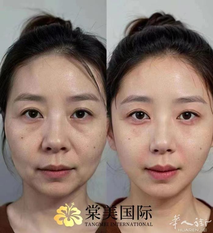 抗衰一定越是‬早越好： 从皮表‬层➠真皮层➠脂肪层➠肌肉层➠筋膜层➠骨膜层 每一