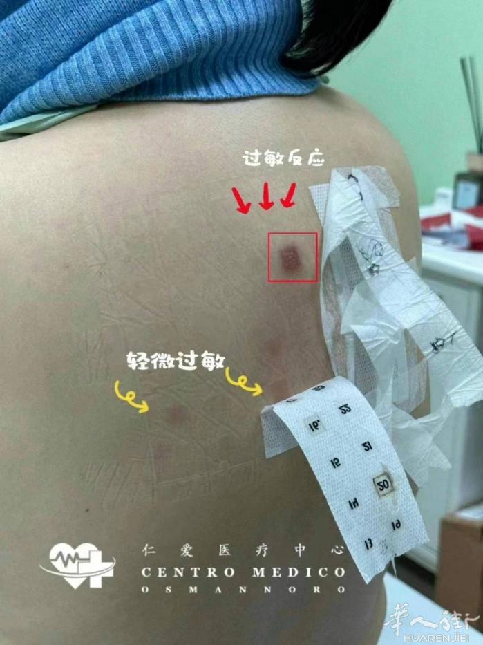 【仁爱医疗中心】本院可约💚 斑贴试验(PatchTest)是确定皮炎湿疹患者的