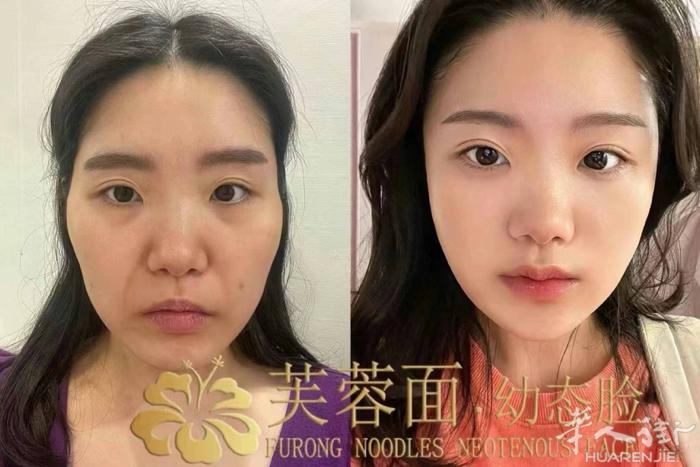 【焕新容颜，好运随行】 想要改变命运，从微调面部开始！我们的轻医美微调整服务，采