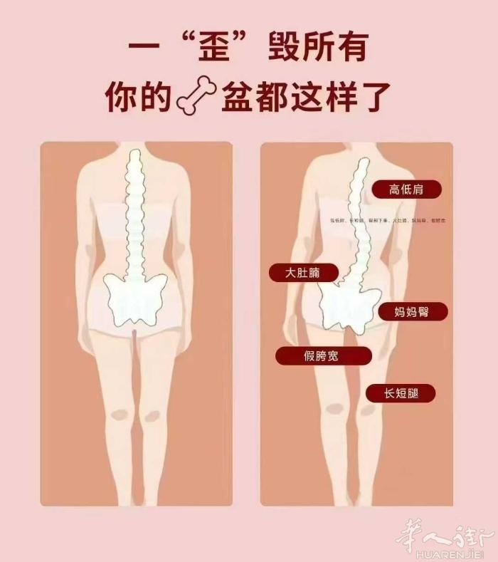 [玫瑰]产后引起的骨盆倾斜，长短脚。高低肩，腰疼，走路不平衡。 想改善产后引起的