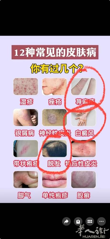 皮肤病问题，看看你是哪一种，可以直接联系我，无副作用，治疗皮肤病效果好，一个星期