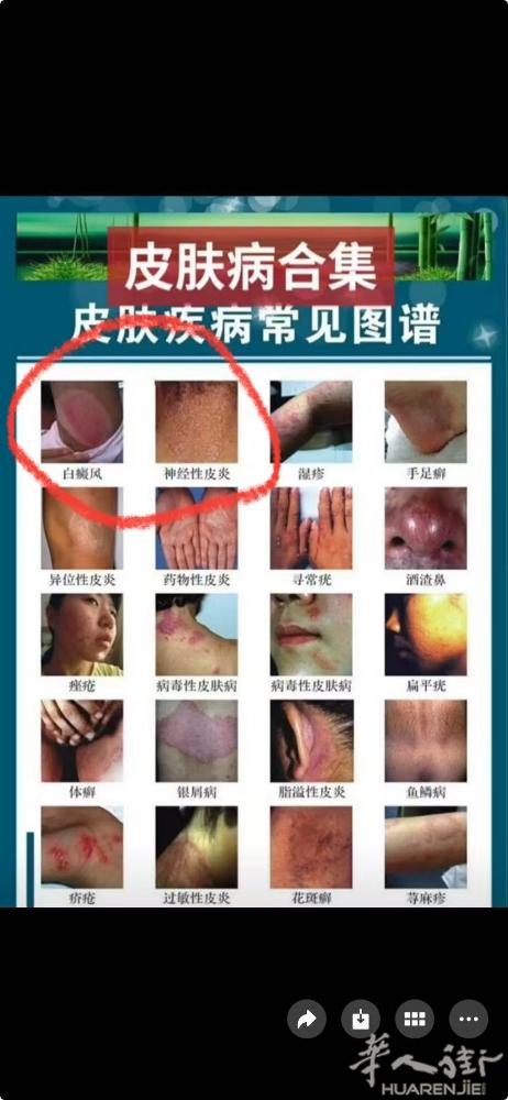 看看你是哪种皮肤病，治愈率百分百，需要的联系，各种皮肤病咨询