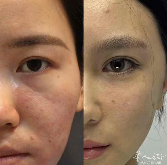 面部微调，随做随走，看不出哪里动了，就是好看了!
