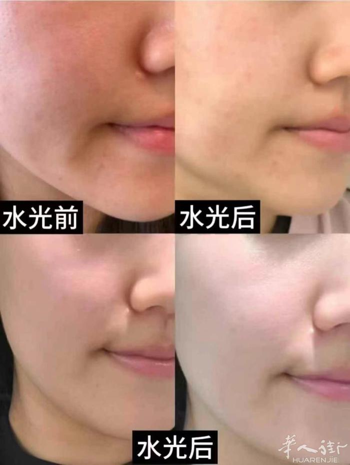 雪芙汀医美工作室：手术类无痕提眉外吸眼袋内吸眼袋。 针剂
