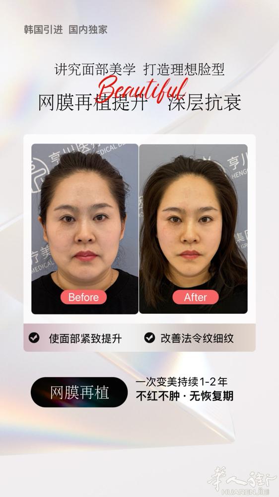 亨川《网膜再植》全球最顶尖抗衰技术，一次性解决泪沟，法令纹，木偶纹，面颊凹陷等所
