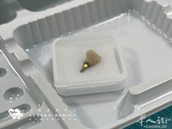 【仁爱医疗中心】种植牙🦷 ✨​选择仁爱，选择安心✨ ​正如同这位客人选择了品质